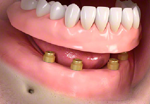 hambaimplantaadid katteprotees