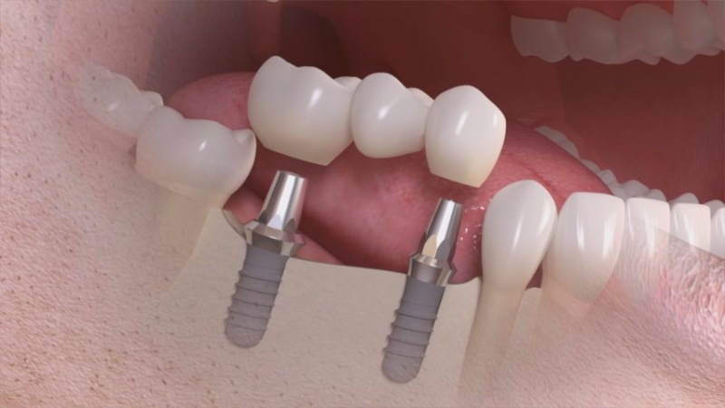 hambaimplantaadid sild