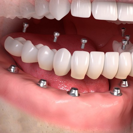hambaimplantaadid sildprotees