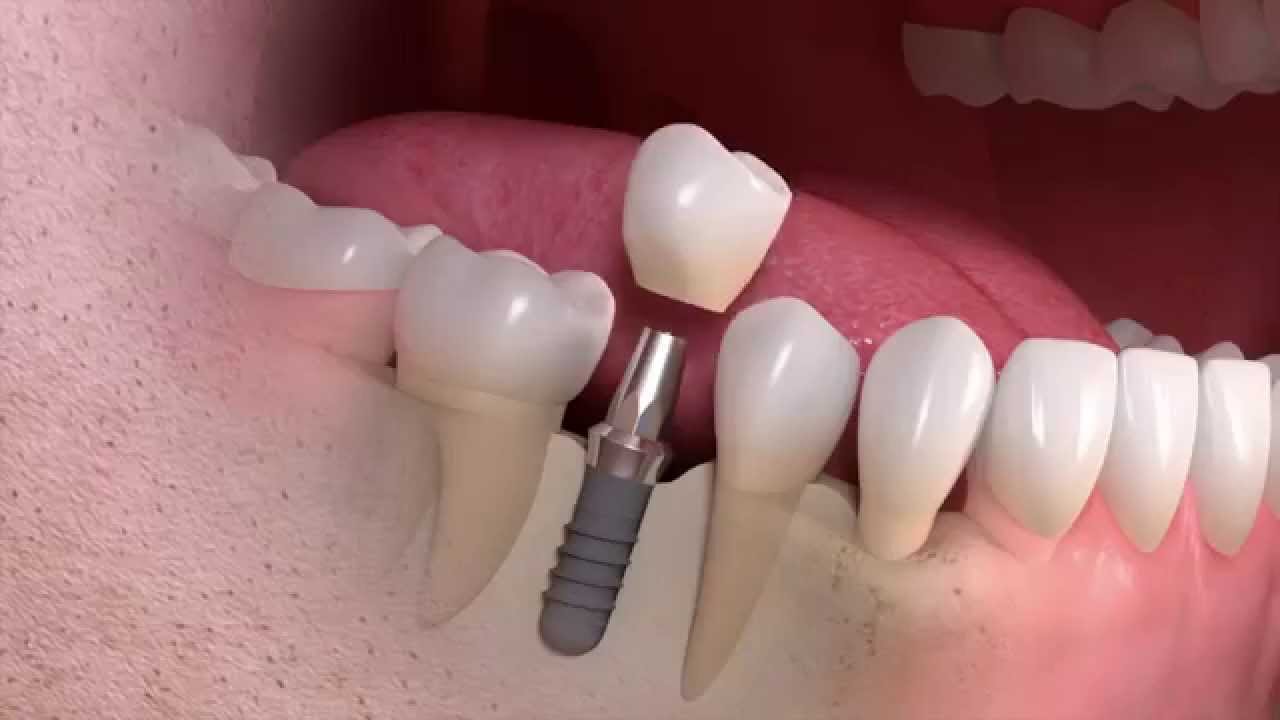 hambaimplantaadid Tartus